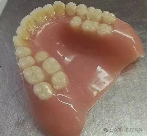 全口义齿图片,完美复刻牙齿之美