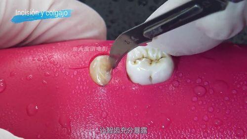 智齿拔除视频,视频带你直观了解拔牙体验