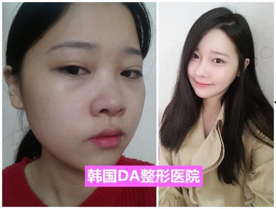 韩国整容手术,美丽背后的秘密与争议