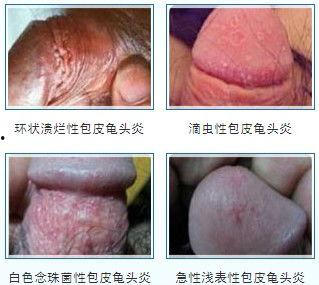 龟头溃烂图片,病因、症状及预防措施