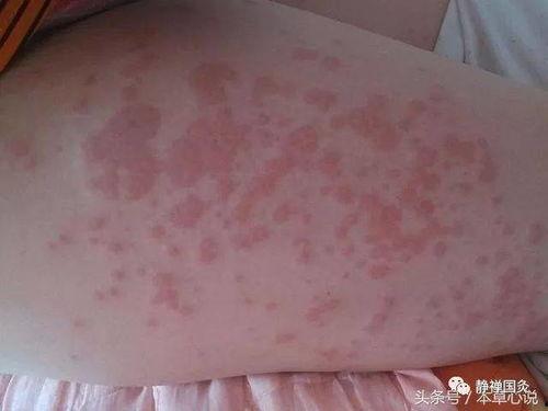 阴部湿疹图片大全,阴部湿疹症状图解与防治要点