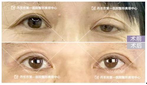 做失败的双眼皮图片,美丽变惊悚，揭秘手术风险与术后护理