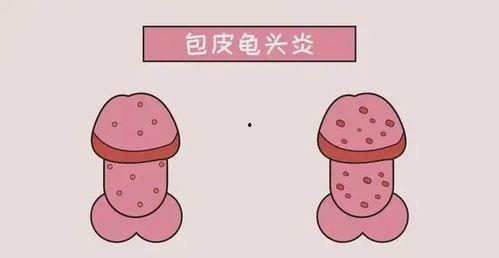 男性龟头炎图片大全,男性龟头炎症状图解与防治要点