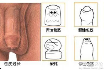 男性龟头炎图片大全,男性龟头炎症状图解与防治要点