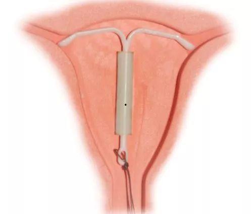 腺肌症图片,深度解读腺体与肌层病变