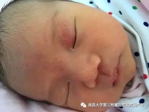 新生儿红斑图片大全,常见症状与护理要点