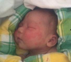 新生儿红斑图片大全,常见症状与护理要点