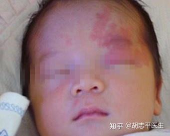 新生儿红斑图片大全,常见症状与护理要点