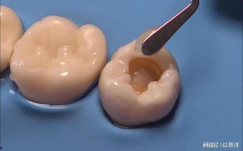 补牙图片,见证牙齿修复的神奇蜕变